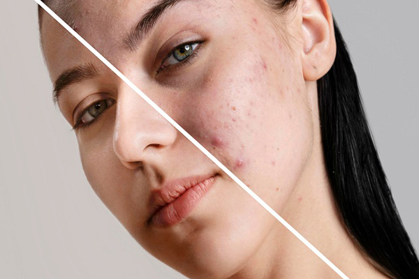 چگونه از جوش زدن جلوگیری کنیم